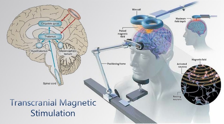 rTMS(TMS)