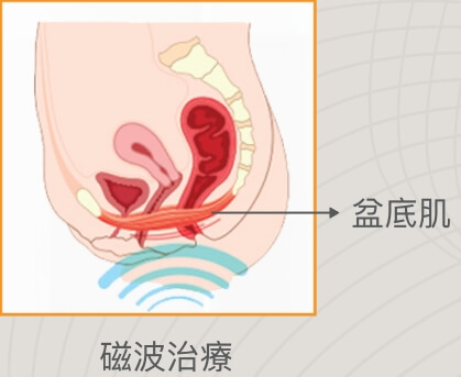 尿失禁漏尿