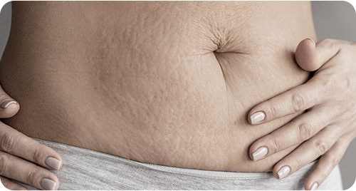 產後鬆弛型 聚焦超音波 熱能緊膚