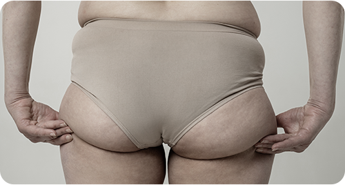 下半身囤脂型 冷凍減脂 電磁增肌