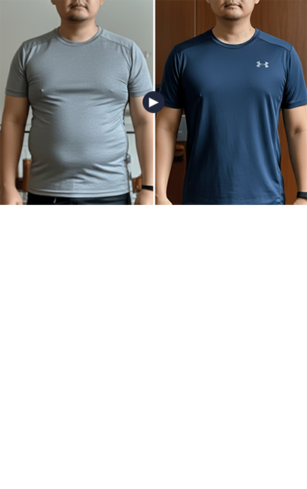 男性啤酒肚 悠美體雕療程