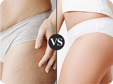 緊緻膚質線條 熨平鬆垮表皮紋路:產後修復、橘皮剋星