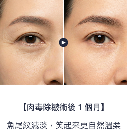 魚尾紋減淡，笑起來更自然溫柔