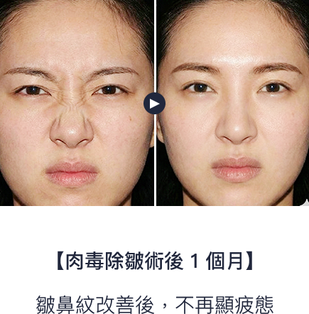 皺鼻紋改善後，表情更放鬆自然，不再顯疲態