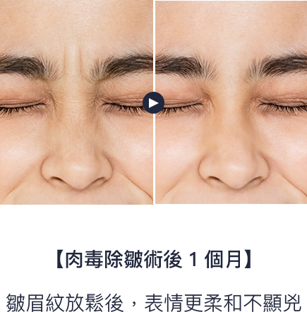 皺眉紋放鬆後，表情更柔和不顯兇
