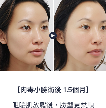 咀嚼肌放鬆後，臉型更柔順