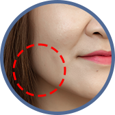 咀嚼肌太發達，臉變大又方，總是要修修臉？